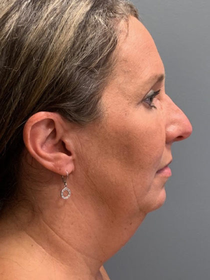 Deep Plane Neck Lift Before & After Patient #3746