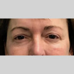 Blepharoplasty Before & After Patient #3839