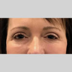 Blepharoplasty Before & After Patient #3839