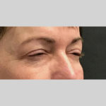 Blepharoplasty Before & After Patient #3839