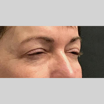 Blepharoplasty Before & After Patient #3839