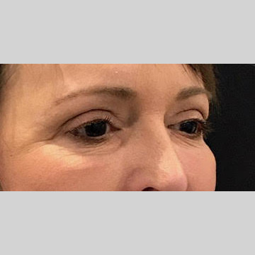 Blepharoplasty Before & After Patient #3839