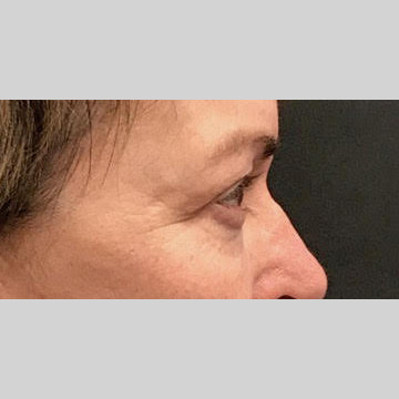 Blepharoplasty Before & After Patient #3839