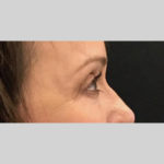 Blepharoplasty Before & After Patient #3839