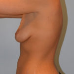 Breast Augmentation Before & After Patient #3643