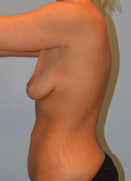 Breast Augmentation Before & After Patient #3643