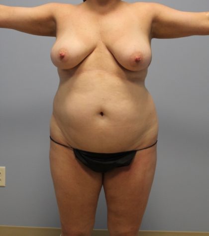 Tummy Tuck Before & After Patient #3603