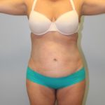 Tummy Tuck Before & After Patient #3603