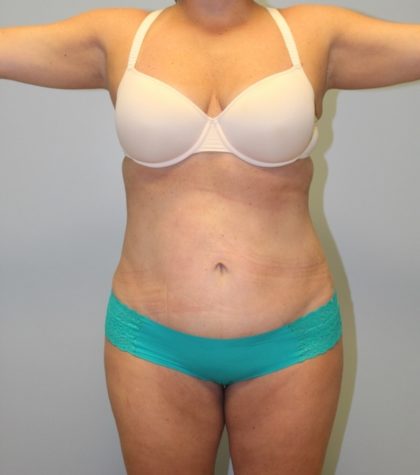 Tummy Tuck Before & After Patient #3603