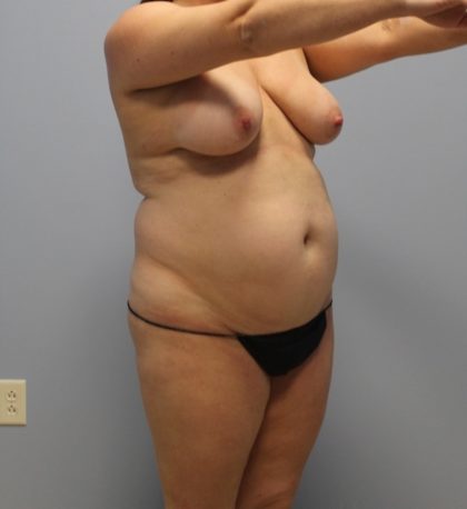 Tummy Tuck Before & After Patient #3603