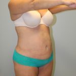 Tummy Tuck Before & After Patient #3603