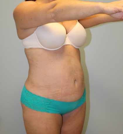 Tummy Tuck Before & After Patient #3603