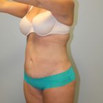 Tummy Tuck Before & After Patient #3603