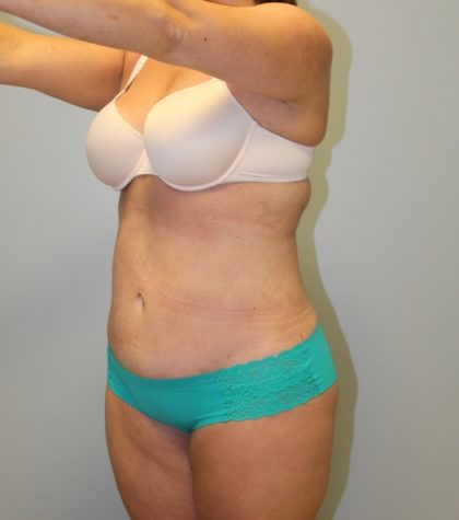 Tummy Tuck Before & After Patient #3603