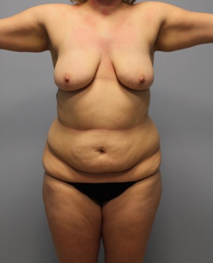 Tummy Tuck Before & After Patient #3615