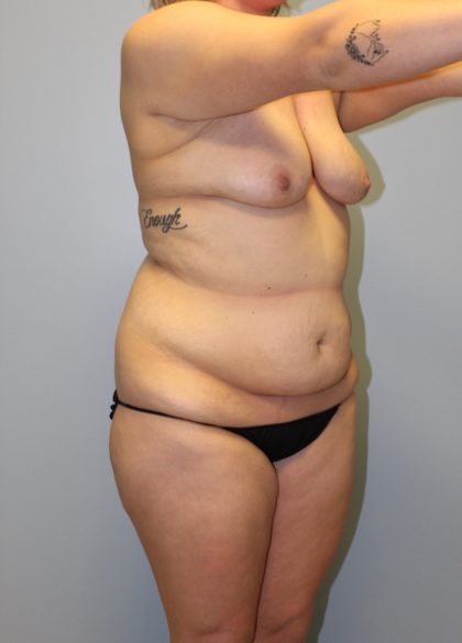 Tummy Tuck Before & After Patient #3615