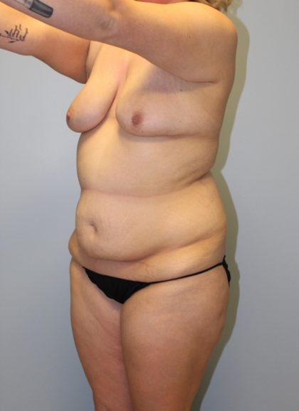 Tummy Tuck Before & After Patient #3615
