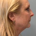 Neck Lift Before & After Patient #3739