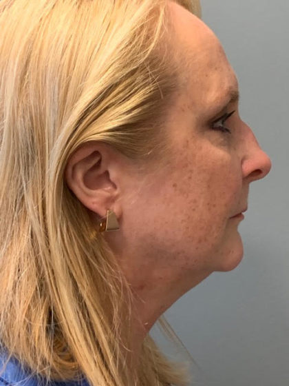 Neck Lift Before & After Patient #3739