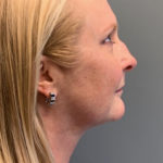 Neck Lift Before & After Patient #3739