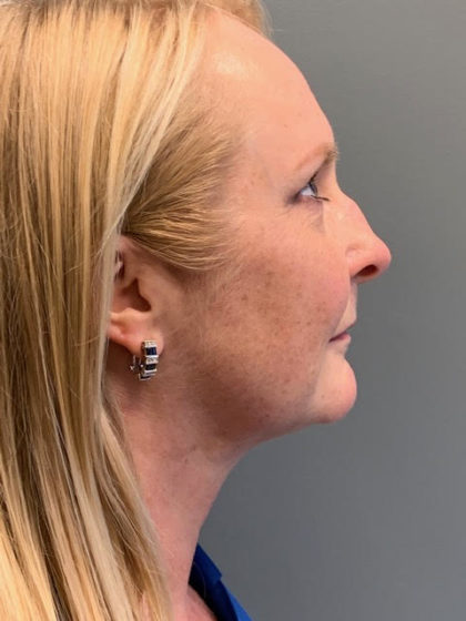 Neck Lift Before & After Patient #3739