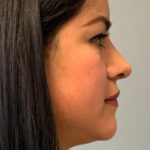 Rhinoplasty Before & After Patient #3793