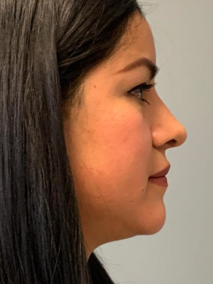 Rhinoplasty Before & After Patient #3793