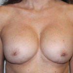 Corrective Breast Procedures Before & After Patient #4001