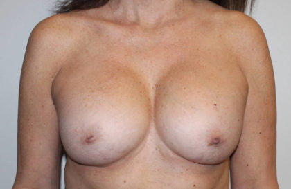 Corrective Breast Procedures Before & After Patient #4001