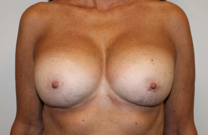 Corrective Breast Procedures Before & After Patient #4001