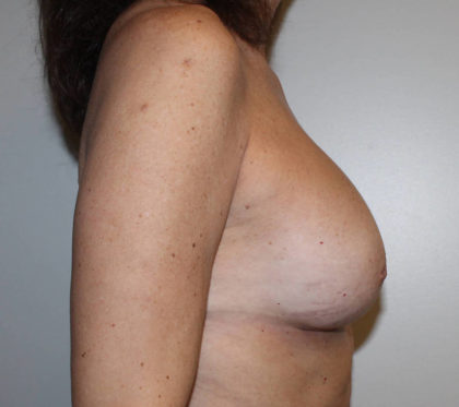 Corrective Breast Procedures Before & After Patient #4001