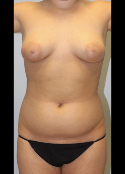 Liposuction Before & After Patient #3959