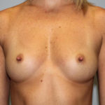 Breast Augmentation Before & After Patient #4066