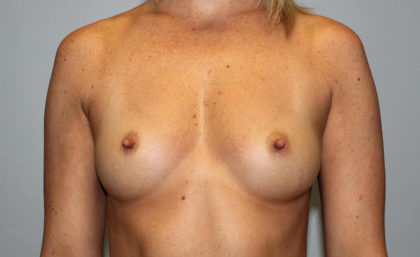 Breast Augmentation Before & After Patient #4066