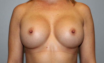 Breast Augmentation Before & After Patient #4066