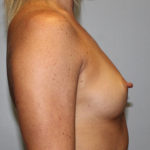 Breast Augmentation Before & After Patient #4066