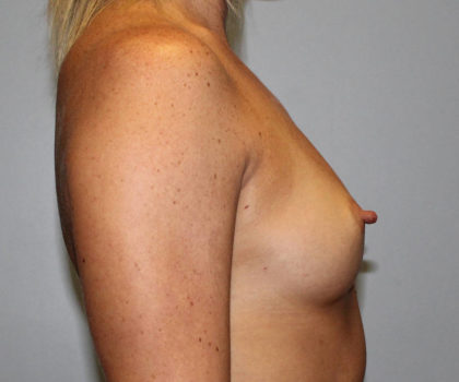 Breast Augmentation Before & After Patient #4066