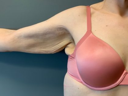 Arm Lift (Scarless Arm Lift) Before & After Patient #4077