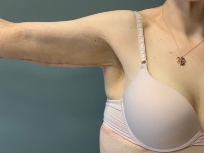 Arm Lift (Scarless Arm Lift) Before & After Patient #4077