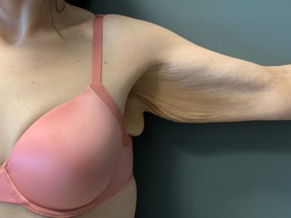 Arm Lift (Scarless Arm Lift) Before & After Patient #4077