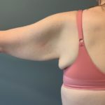 Arm Lift (Scarless Arm Lift) Before & After Patient #4077