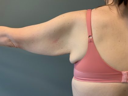 Arm Lift (Scarless Arm Lift) Before & After Patient #4077