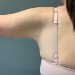 Arm Lift (Scarless Arm Lift) Before & After Patient #4077