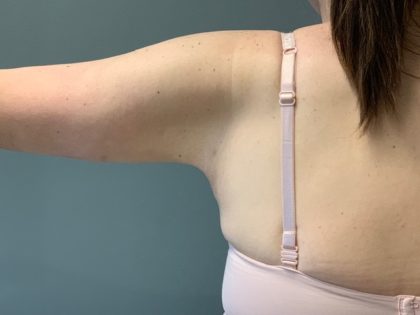 Arm Lift (Scarless Arm Lift) Before & After Patient #4077
