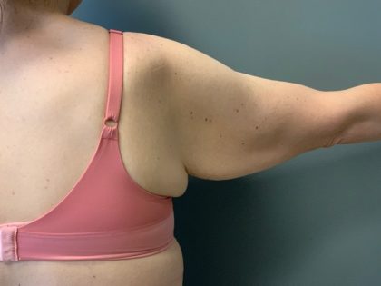 Arm Lift (Scarless Arm Lift) Before & After Patient #4077