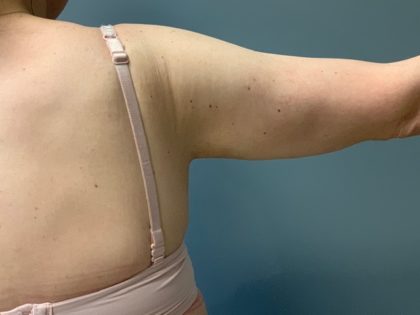 Arm Lift (Scarless Arm Lift) Before & After Patient #4077