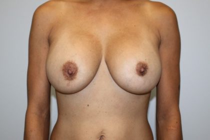 Breast Augmentation Before & After Patient #4051