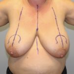 Breast Lift Before & After Patient #4039