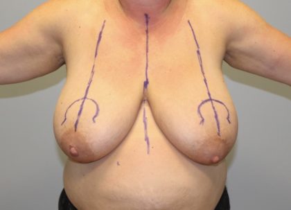 Breast Lift Before & After Patient #4039