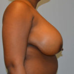 Breast Reduction Before & After Patient #4014